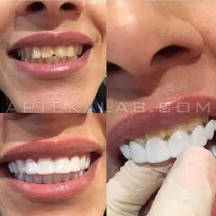 Snap-On Smile в аптеке в Шале